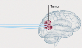 Mit Hadronen Krebs besiegen